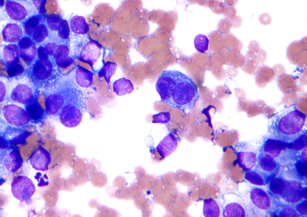 Melanoma hücreleri (mavi ile boyalı olanlar)