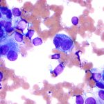 Melanoma_-_cytology_field_stain