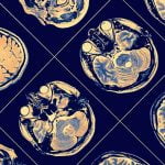 Yeni Çalışmaya Göre Alzheimer, 6 Farklı Grup Olarak Ele Alınmalı