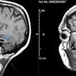 Korkutan Bir Vaka Çalışması, Kulaklarınızı Kulak Çöpüyle Temizlememeniz Gerektiğini Gösteriyor