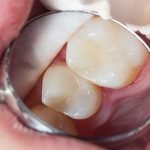 Bağışıklık Sistemimiz, Diş Çürümesine Katkıda Bulunuyor Olabilir