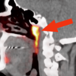 İnsan Kafasının Merkezinde Keşfedilen Yeni Organ