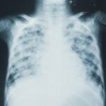 Yapay Zeka, Akciğerlerdeki COVID-19’u Sanal Bir Doktor Gibi Tespit Edebiliyor