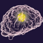 Beyin Tümörleri, Sağlıklı Sinirler ile Bağlantı Oluşturuyor