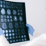 COVID-19 Hastalarındaki Beyin Hasarının İlk Detayları