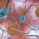 Yeni İlaç, Alzheimer Hastalığının Göstergesi Olan Amiloid Plaklarını Önlüyor