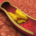 Yüksek Kolesterol Tedavisi İçin Onaylanan ‘Gen Susturma’ Aşısı