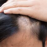 FDA Onaylı İlk Saç Dökülmesi İlacı, Hastaların Yarısında Saç Çıkmasını Sağlıyor