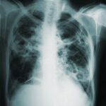 Akciğer İltihabının Olası Sebebi: Mantar Enfeksiyonları